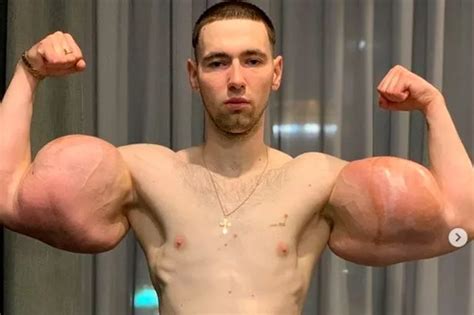 Popeye Bodybuilder Who Injected Fake Muscles Could Lose Use Of Arms Or Worse Daily Star