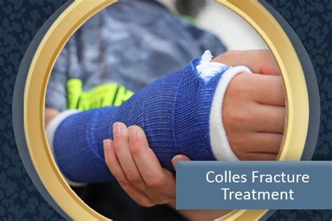 Colles Fracture Treatment All Pro Orthopedics And Sports Medicine