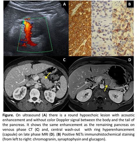 Solid Tumor Of The Pancreas As Unexpected Diagnosis In A Urgent