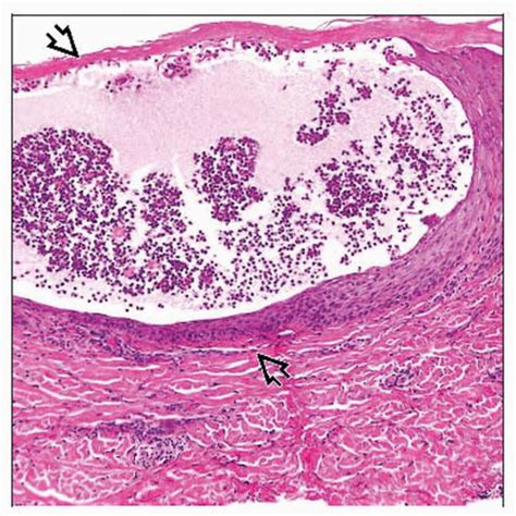 Acropustulosis Of Infancy Basicmedical Key