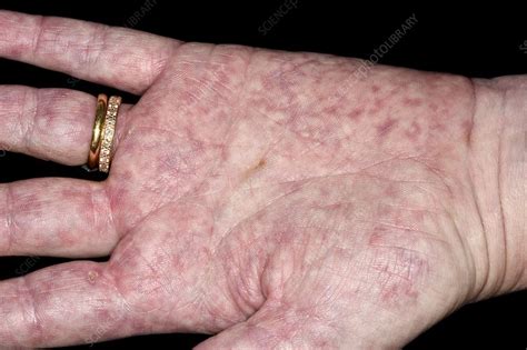 Vasculitis In Lupus Stock Image C0475903 Science Photo Library