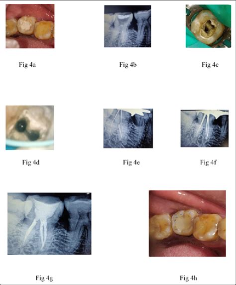 A Preoperative Clinical Photograph 4b Preoperative Radiograph 4c