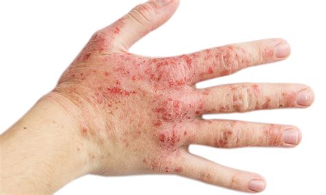 What Are The 7 Different Types Of Eczema Dr Batras