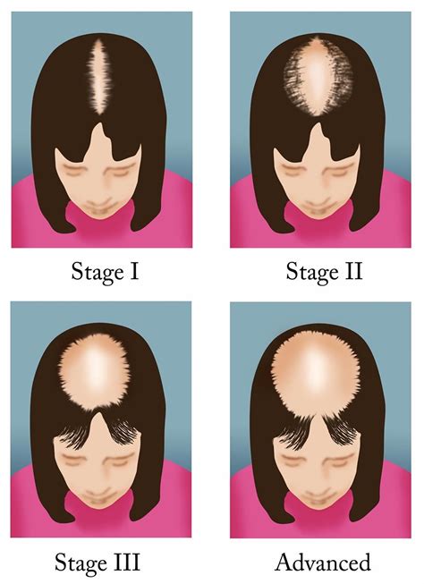 Early Female Pattern Baldness