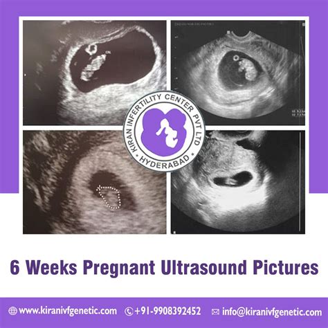 Babys Growth At 6 Weeks Pregnant Through Ultrasound Pictures