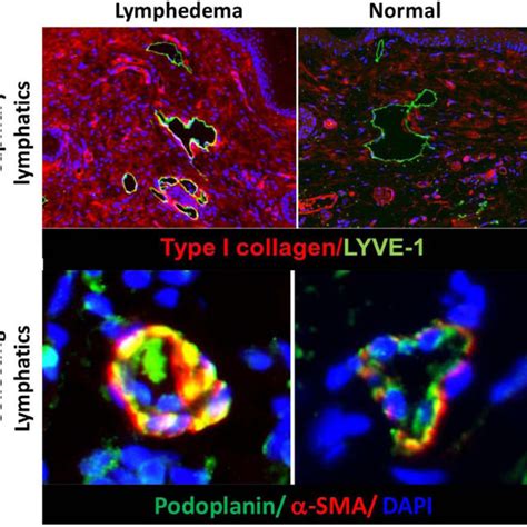 Lymphedema Results In Collagen Deposition And Fibrosis Of Capillary