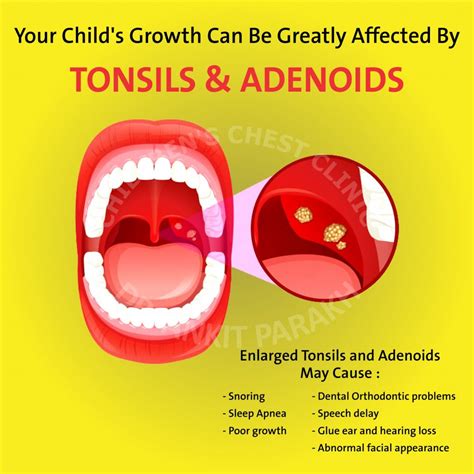Enlarged Tonsils And Adenoids In Children Diagnosis And Treatment Dr