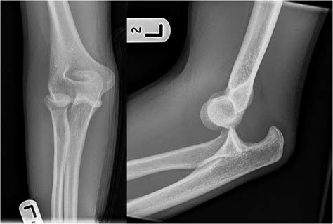 Irreducible Posterolateral Elbow Dislocation A Rare Injury Bmj Case