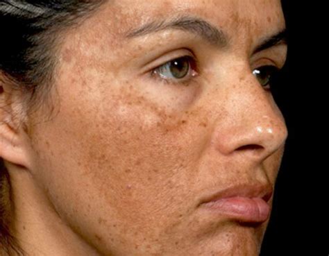 Your Guide To Melasma How To Treat Tricky Dark Spots Dr Pimple Popper