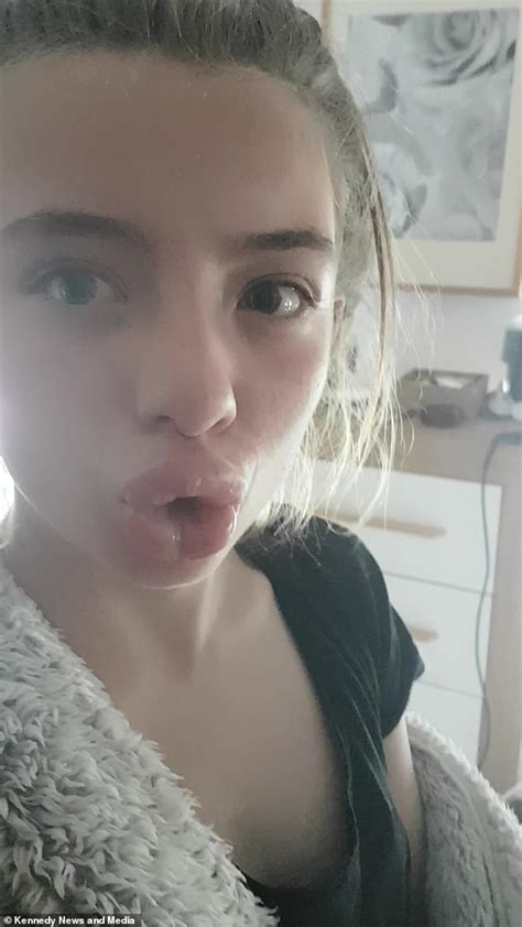 Mother In Stitches As Teenage Daughter Gets Stuck With Duck Lips For Two Days Daily Mail Online