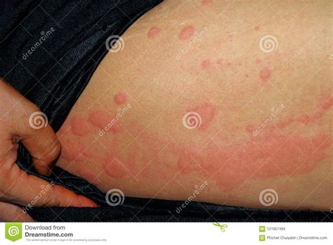 Hives Rash Stock Photos Royalty Free Stock Images