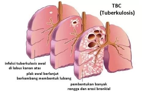 Gejala Penyebab Dan Cara Mengobati Tuberkulosis TBC Harian Haluan