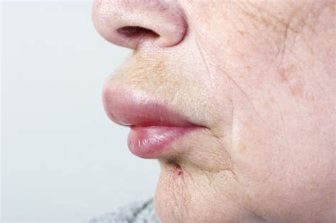 Itchy Lips The Common Causes And Treatment Remedies