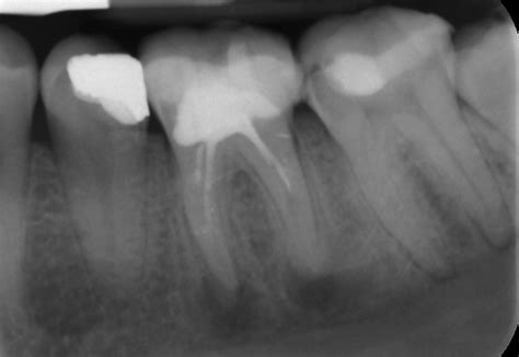 Glasvezelstiftopbouw Praktijk Endodontie