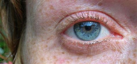 Researchers Have Proved That Gene Variants Associated With Red Hair Pale Skin And Freckles Are