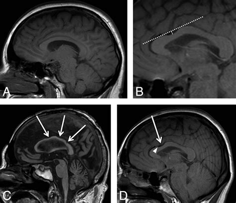 Defining The Normal Dorsal Contour Of The Corpus Callosum With Time American Journal Of