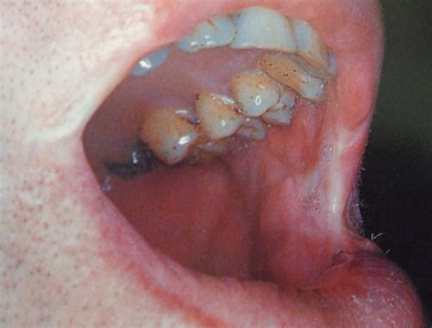 Napalmhuig Sore Mouth And Gums Pregnancy
