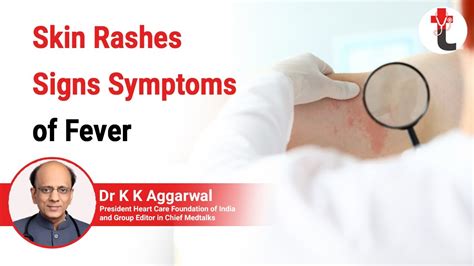 Skin Rashes Signs Symptoms Of Fever Mnemonic Fever And Rash Fever