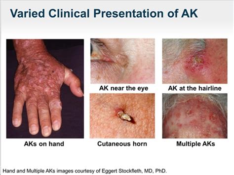 Actinic Keratosis And Field Cancerization New Insights Transcript