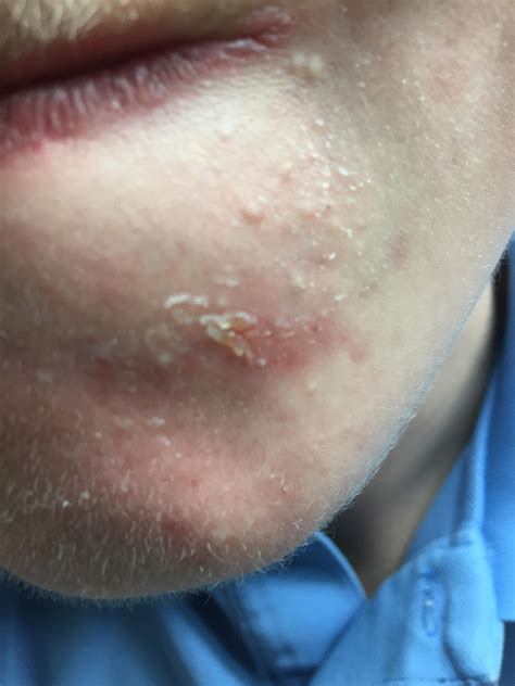 Small White Pimple On Face