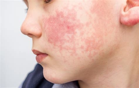 Face Sunscreen Allergy Rash Harmed By Sunscreen What Parents Need To