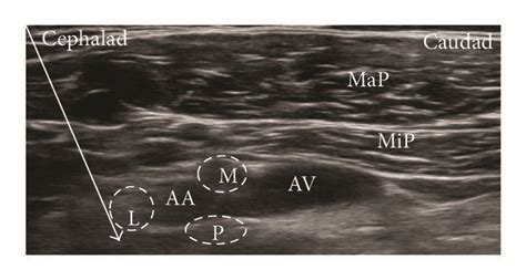 Ultrasound Guided Brachial Plexus Blocks Using A Short Axis In Plane