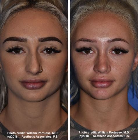 Before And After Rhinoplasty Photos And Images