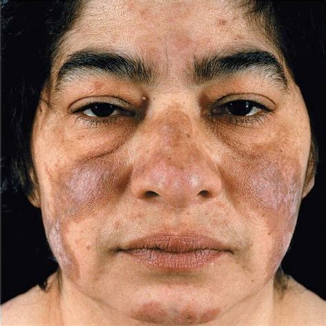 The Skin In Immune Autoimmune And Rheumatic Disorders Fitzpatricks