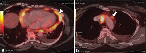 A Rare Case Of Primary Malignant Pericardial Mesothelioma Journal Of