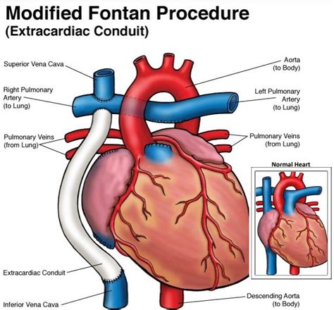 Fonton Procedure Fetal Health Foundation