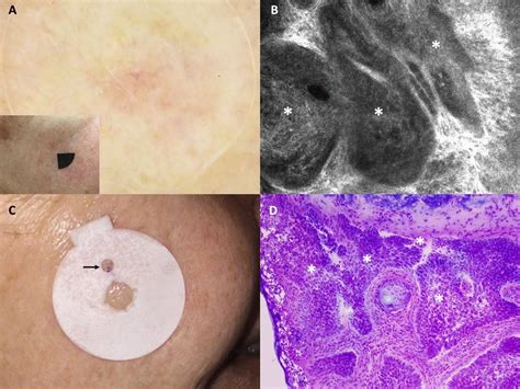 Basal Cell Carcinoma Bcc Case 2 A Dermoscopic Features Of A Pink