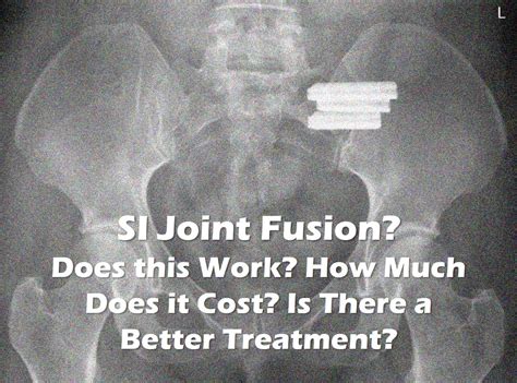 Si Joint Fusion Success Rate Science Relief