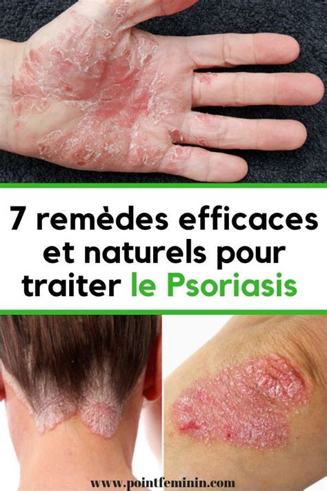7 Remèdes Efficaces Et Naturels Pour Traiter Le Psoriasis Avec Images