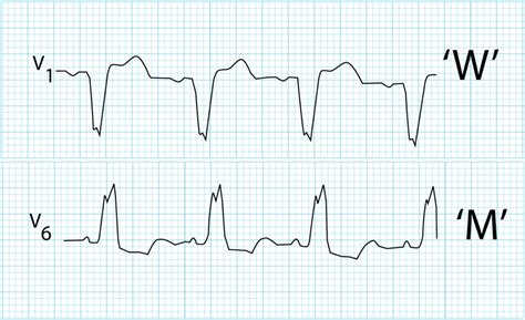 The St Segment Litfl Ecg Library Basics