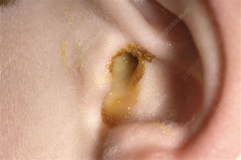 ear infection stock image m157 0069 science photo library