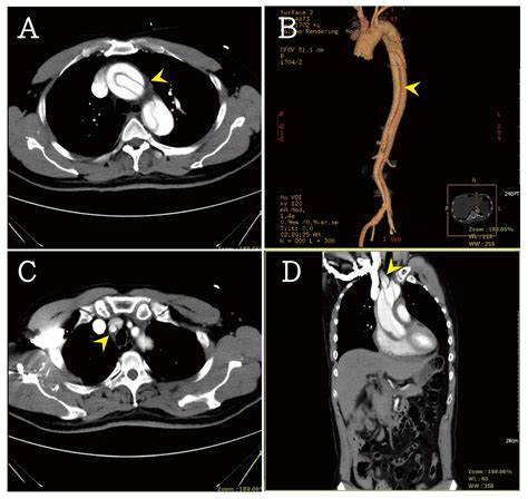 Reports Free Full Text Type A Aortic Dissection Presenting With