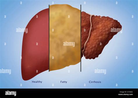 Understanding Fatty Liver Disease And Its Treatment Protocol Infographic