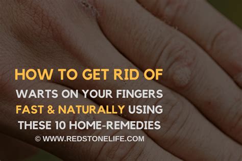 How To Get Rid Of Warts On Your Fingers Fast Naturally 10 Ways