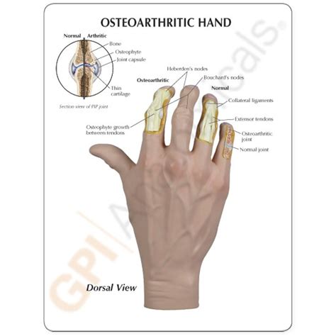 Hand And Finger Osteoarthritis Model Clinical Charts And Supplies