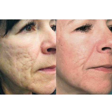 Tetra Coolpeel® Co2 Laser Skin Resurfacing Restoremd