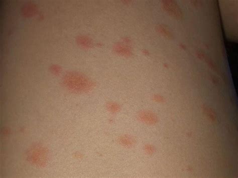 Rashes Can Occur After Covid Vaccine But Dermatologists Say Dont