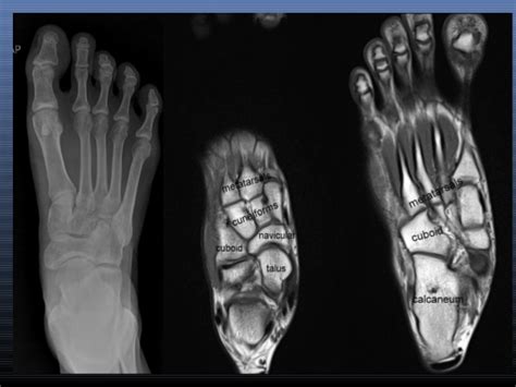 This article discusses the anatomy, supply, function and clinical relevance of the dorsal muscles of the foot. MRI IN FOOT PAIN
