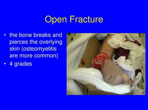 Ppt Orthopedic Injuries And Immobilization Powerpoint Presentation