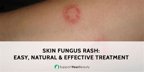 People in their 40s will often develop fine lines and textural irregularities, robbing their skin of youthful suppleness and glow. Skin Fungus Rash: Easy, Natural, and Effective Treatment