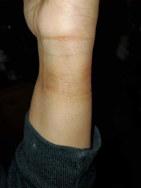 Solved Really Bad Wrist Burn From S3 Sport Samsung Community 460933