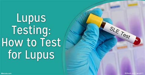 How To Test For Lupus