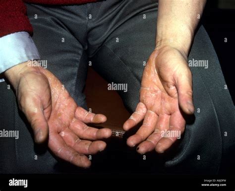 Ringworm Of The Hands Tinea Manus Particularly The Palms And The