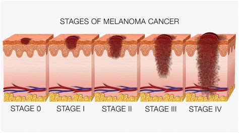 What Is Stage 3 Skin Cancer