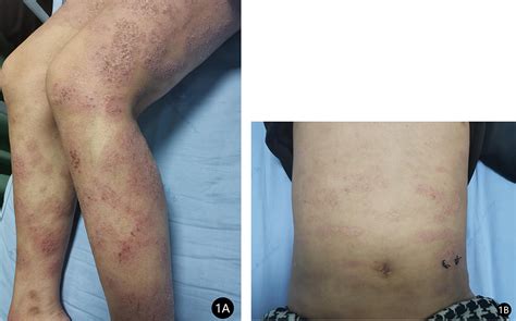 Pustular Psoriasis In A Patient Treated With Dupilumab Ccid
