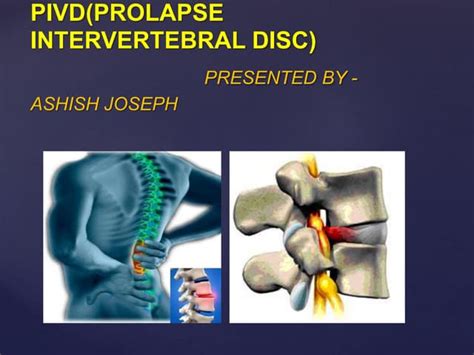 Intervertebral Disc Prolapse Pivd Ppt